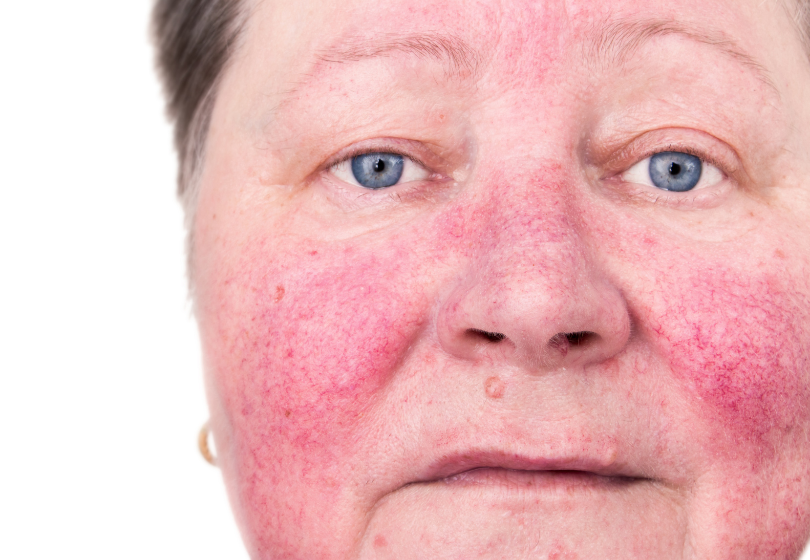 How to treat rosacea acne