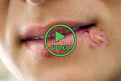 Some Facts You Absolutely Need to Know About Herpes